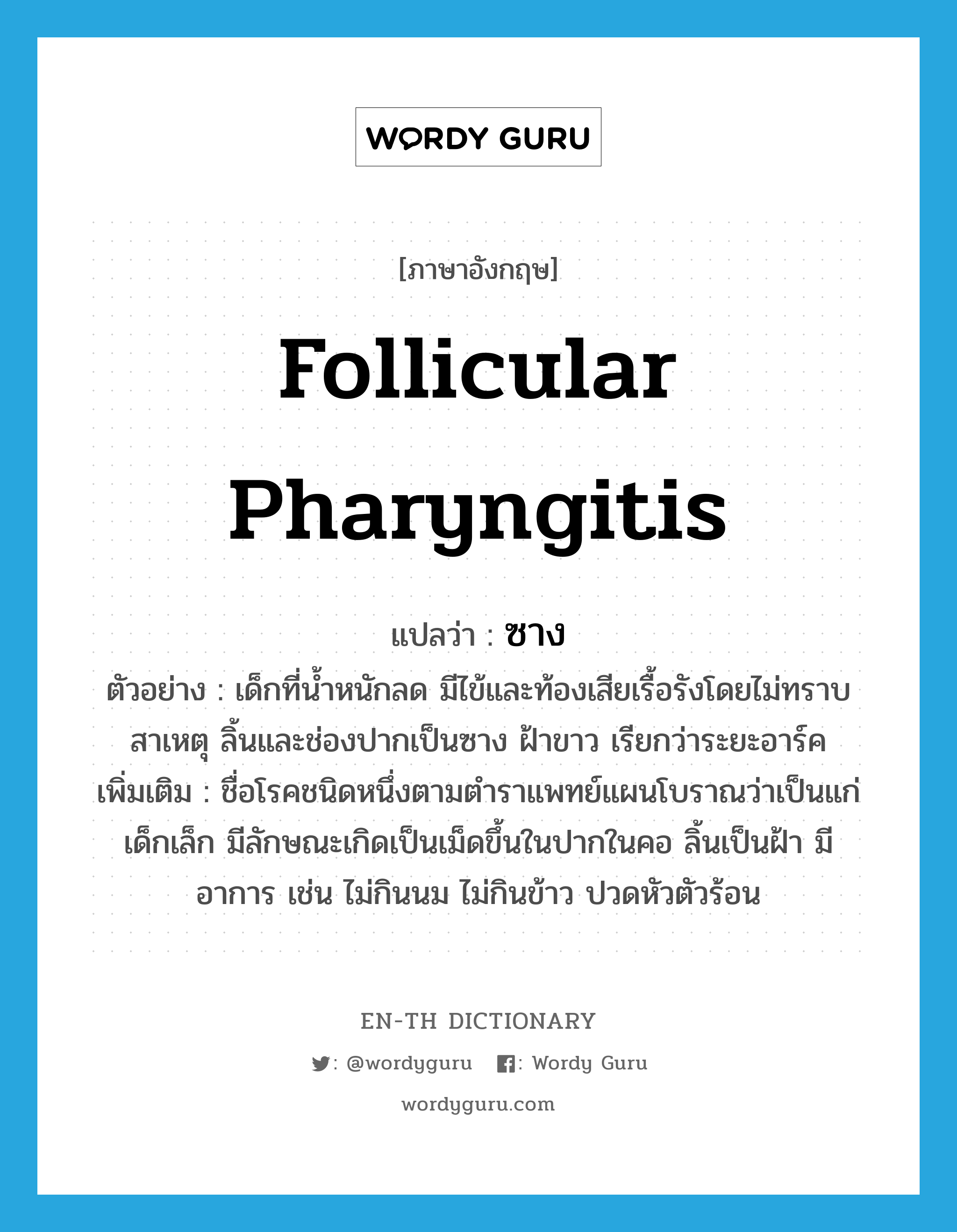 follicular pharyngitis แปลว่า?, คำศัพท์ภาษาอังกฤษ follicular pharyngitis แปลว่า ซาง ประเภท N ตัวอย่าง เด็กที่น้ำหนักลด มีไข้และท้องเสียเรื้อรังโดยไม่ทราบสาเหตุ ลิ้นและช่องปากเป็นซาง ฝ้าขาว เรียกว่าระยะอาร์ค เพิ่มเติม ชื่อโรคชนิดหนึ่งตามตำราแพทย์แผนโบราณว่าเป็นแก่เด็กเล็ก มีลักษณะเกิดเป็นเม็ดขึ้นในปากในคอ ลิ้นเป็นฝ้า มีอาการ เช่น ไม่กินนม ไม่กินข้าว ปวดหัวตัวร้อน หมวด N